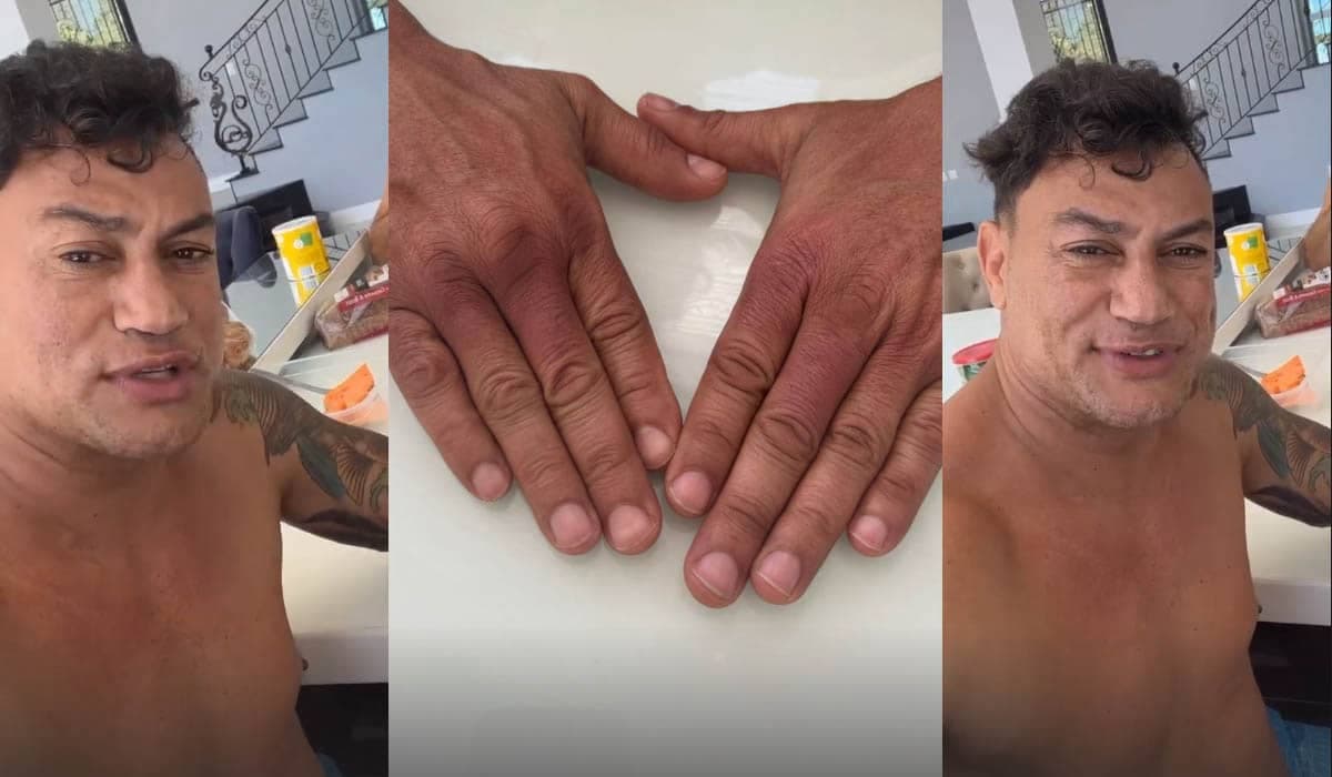 Popó exibe mãos roxas após luta com Whindersson Nunes