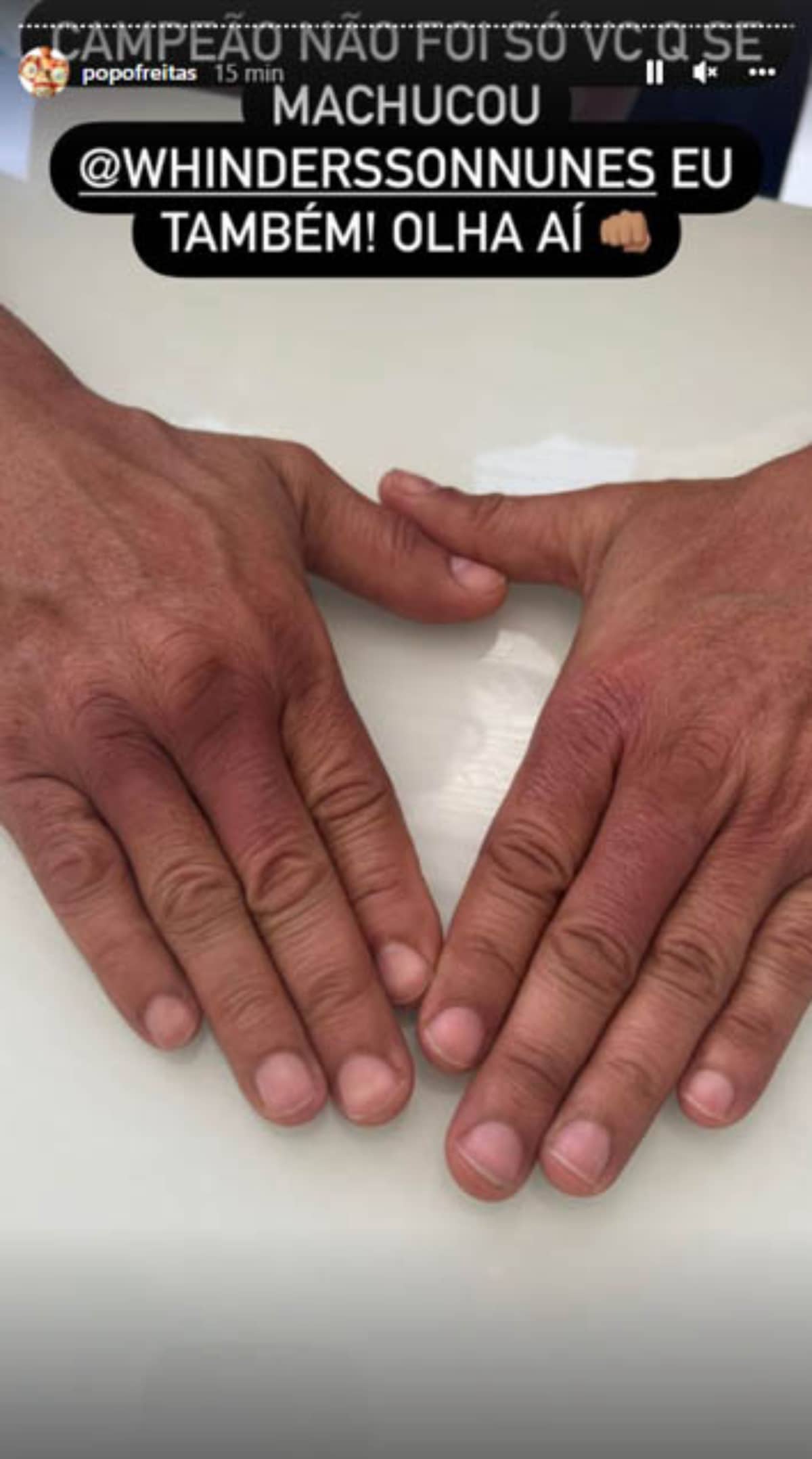 Popó mostrou as mãos roxas após a luta contra Whindersson. Foto: Reprodução / Instagram